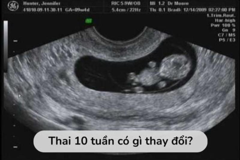 Hình ảnh siêu âm thai 10 tuần rõ nét các chi và cử động